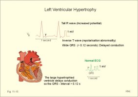 Hypertrophie ventriculaire